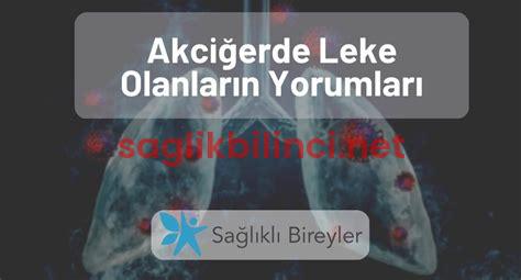 Akciğerde Nodül Olanların Yorumları: Sağlık Sürecine Dair Paylaşımlar
