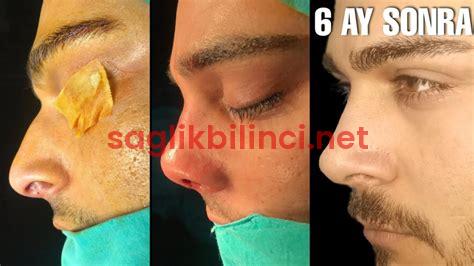 Burun Eti Ameliyatı: Süreç ve İyileşme Bilgileri