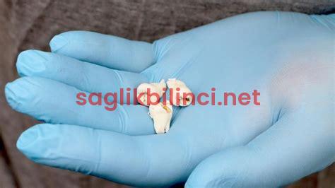 20’lik Diş Çekimi Fiyatları: İşlem Hakkında Bilmeniz Gerekenler