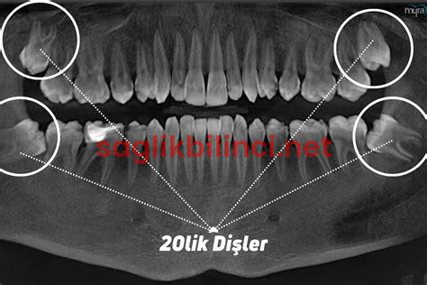 20’lik Diş İltihabı Belirtileri: Dikkat Edilmesi Gerekenler