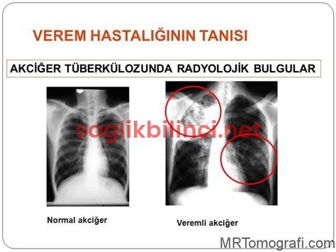 Akciğer Filmi: Süreç, Ne Zaman Çekilir ve Sonuçları