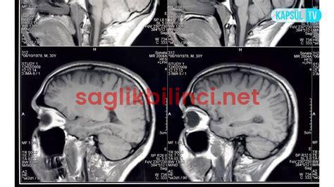 Araknoid Kist: Belirtileri ve Tedavi Seçenekleri