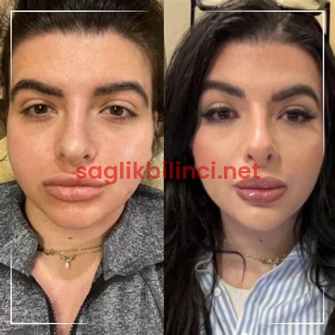 Bişektomi Öncesi Sonrası: Düşünceler ve Öneriler