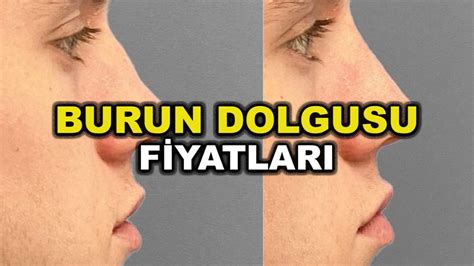 Burun Dolgusu Fiyatları: 2023 İçin Bilgilendirme