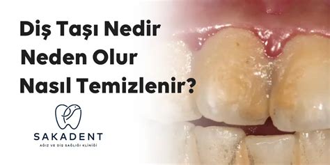 Diş Taşı Neden Olur? Belirtileri ve Önlenmesi