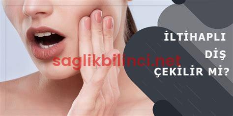 İltihaplı Diş Çekilir Mi? Uzmanların Cevapları