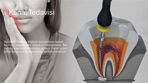 Kanal Tedavisi Sonrası Ağrı: Nasıl Hafifletilir?