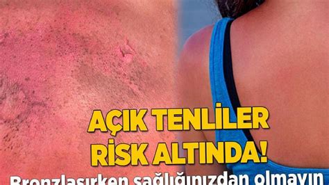 Kuru Sıkılar: Nedenleri ve Tedavi Yöntemleri