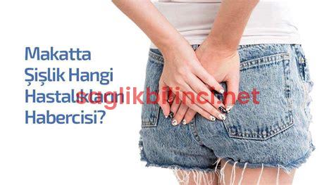 Makatta Şişlik: Belirtiler ve Tedavi Yöntemleri (Resimli)