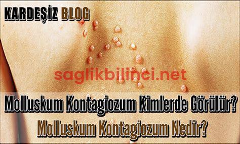 Molluskum Kontagiozum: Belirtileri ve Tedavi Yöntemleri
