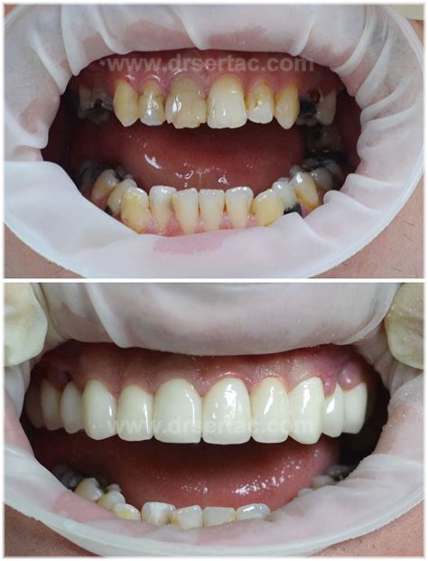 Protez Diş: Türleri ve Bakım Yöntemleri