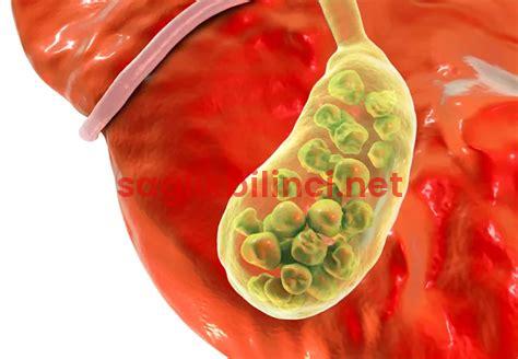 Safra Kesesine Ne İyi Gelir? Doğal Yöntemler