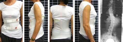 Skolyoz Korsesi: Kullanımı ve Faydaları